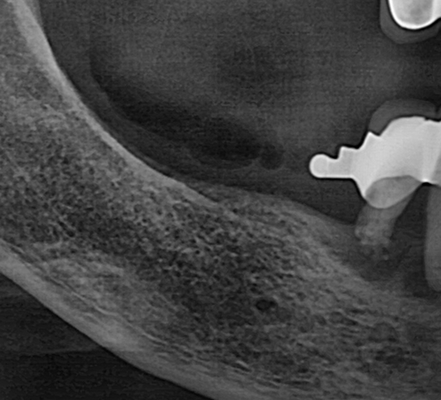 뼈이식 케이스 Before 2