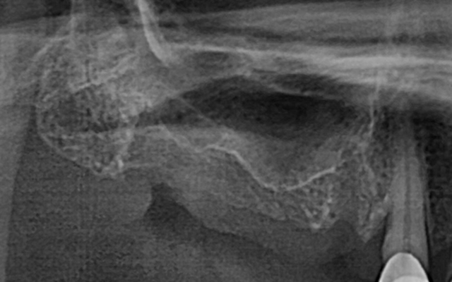 상악동 거상술 Before 2