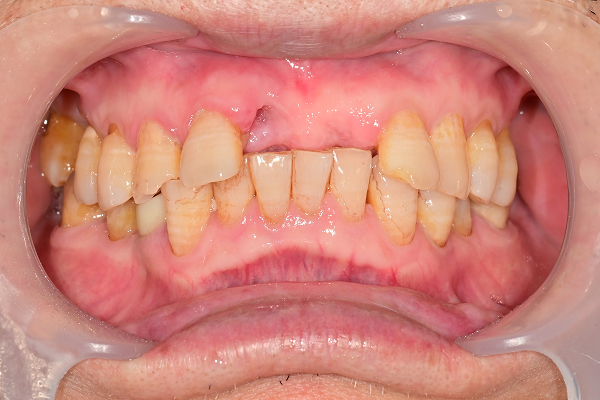 교합거상 케이스 Before 1