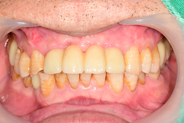 교합거상 케이스 After 1