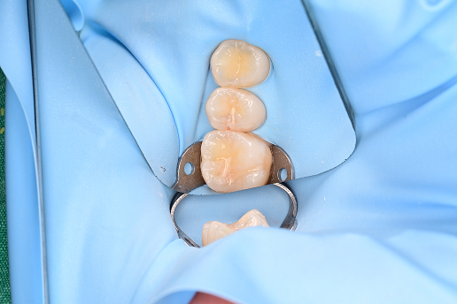 레진 빌드업  Before