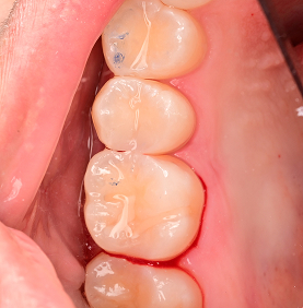 레진 빌드업  After